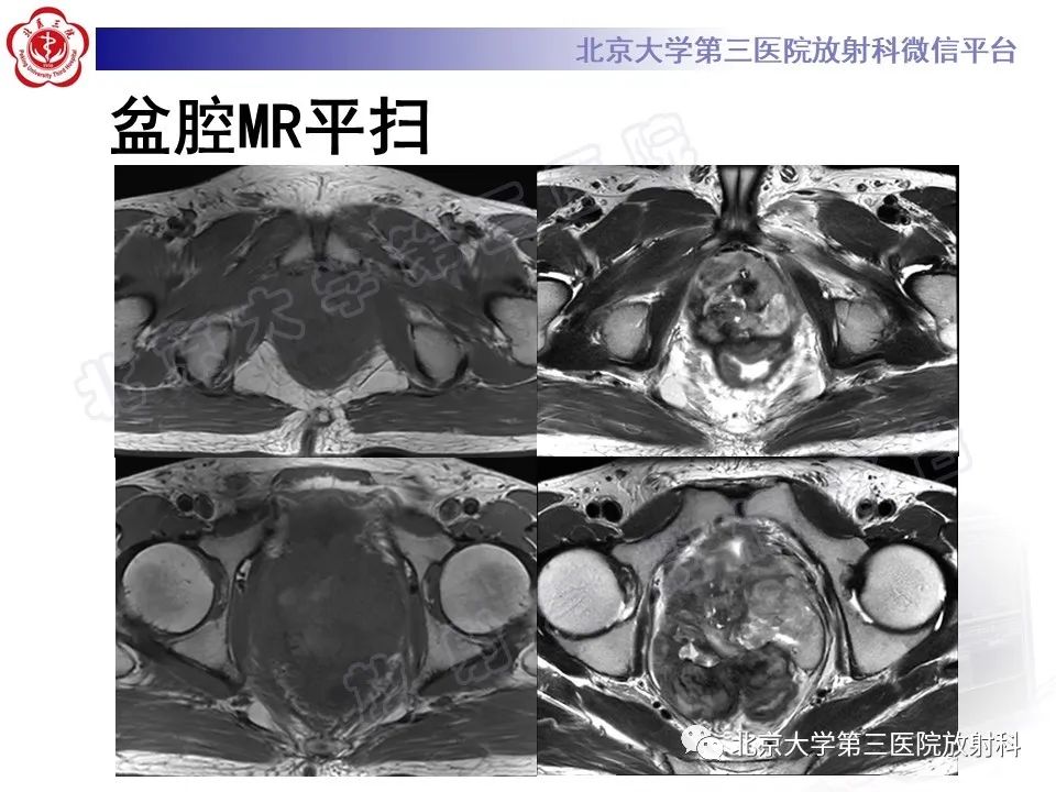 【PPT】前列腺肉瘤-7