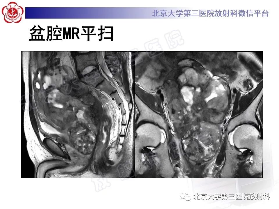 【PPT】前列腺肉瘤-8