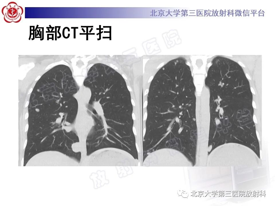 【PPT】前列腺肉瘤-10