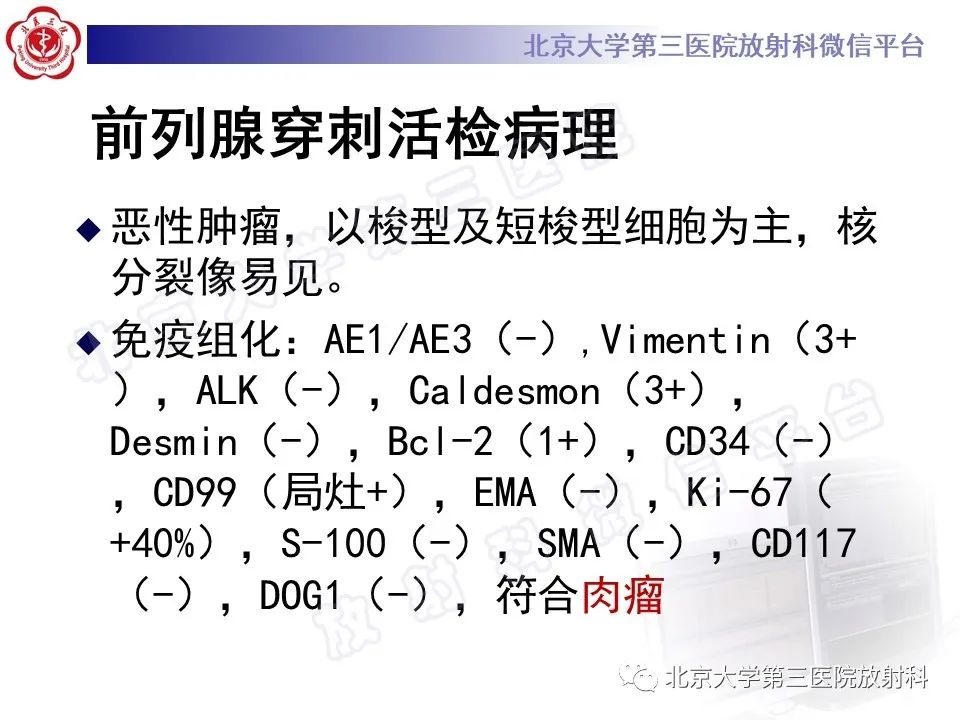 【PPT】前列腺肉瘤-12