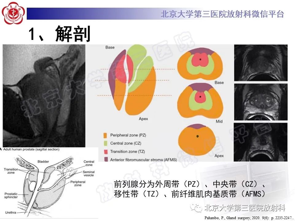 【PPT】前列腺肉瘤-14
