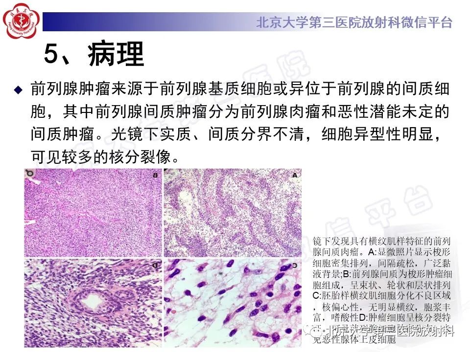 【PPT】前列腺肉瘤-19