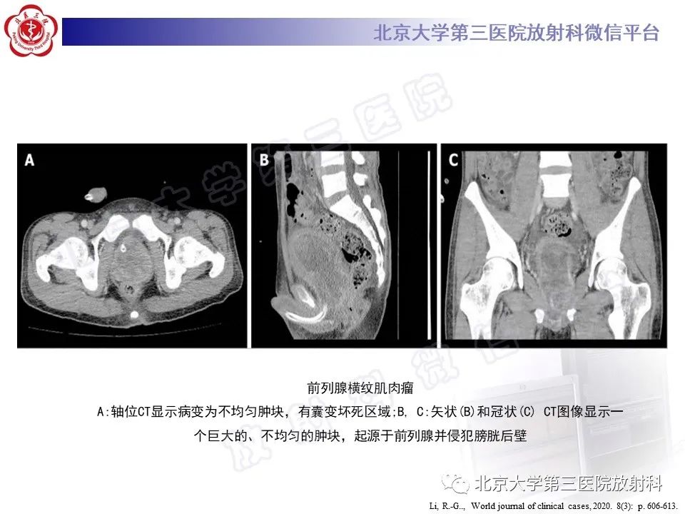 【PPT】前列腺肉瘤-22