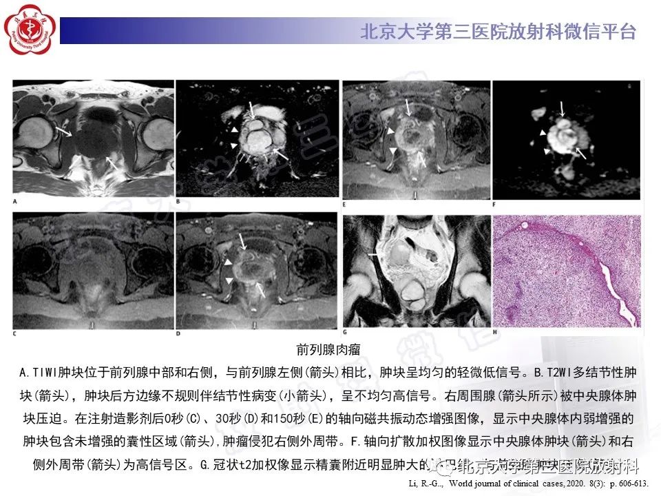 【PPT】前列腺肉瘤-23