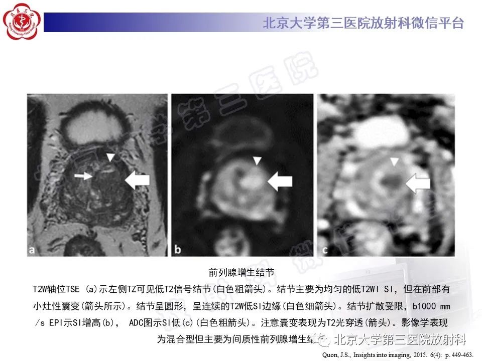 【PPT】前列腺肉瘤-26