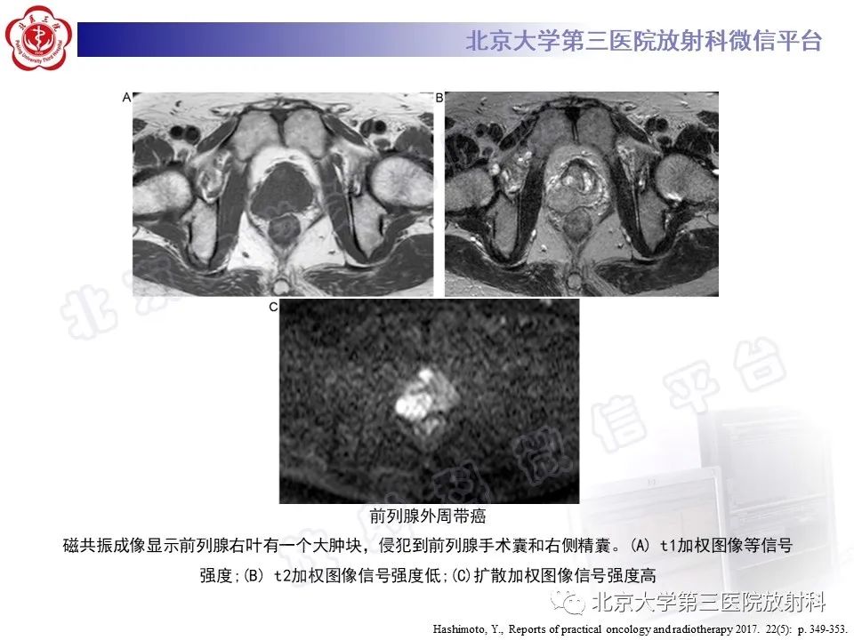 【PPT】前列腺肉瘤-28