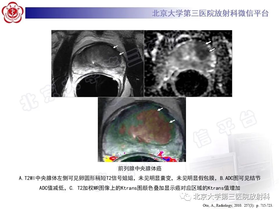 【PPT】前列腺肉瘤-29