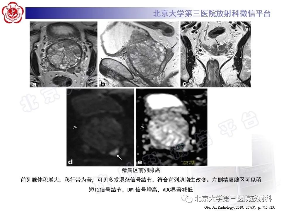 【PPT】前列腺肉瘤-30