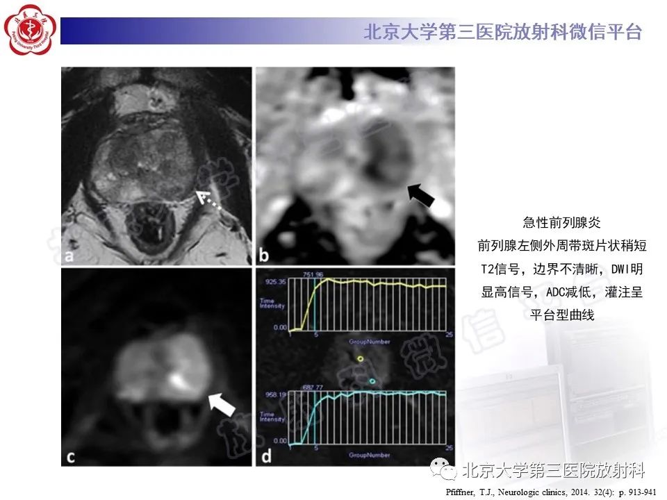【PPT】前列腺肉瘤-32