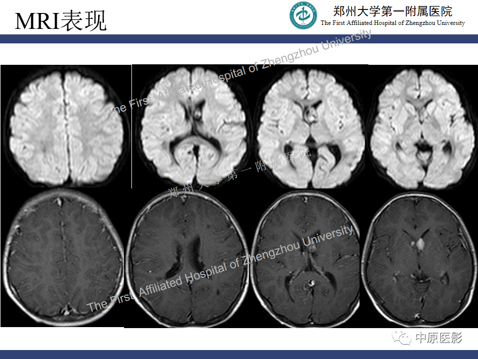 【病例】室管膜下巨细胞星形细胞瘤1例MR影像-5