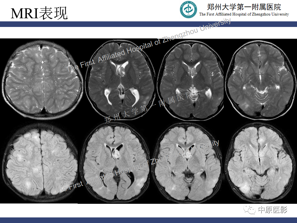 【病例】室管膜下巨细胞星形细胞瘤1例MR影像-4
