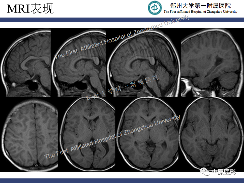 【病例】室管膜下巨细胞星形细胞瘤1例MR影像-3