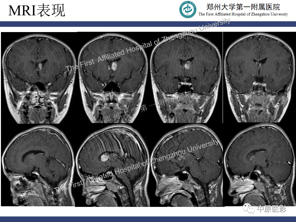 【病例】室管膜下巨细胞星形细胞瘤1例MR影像-6