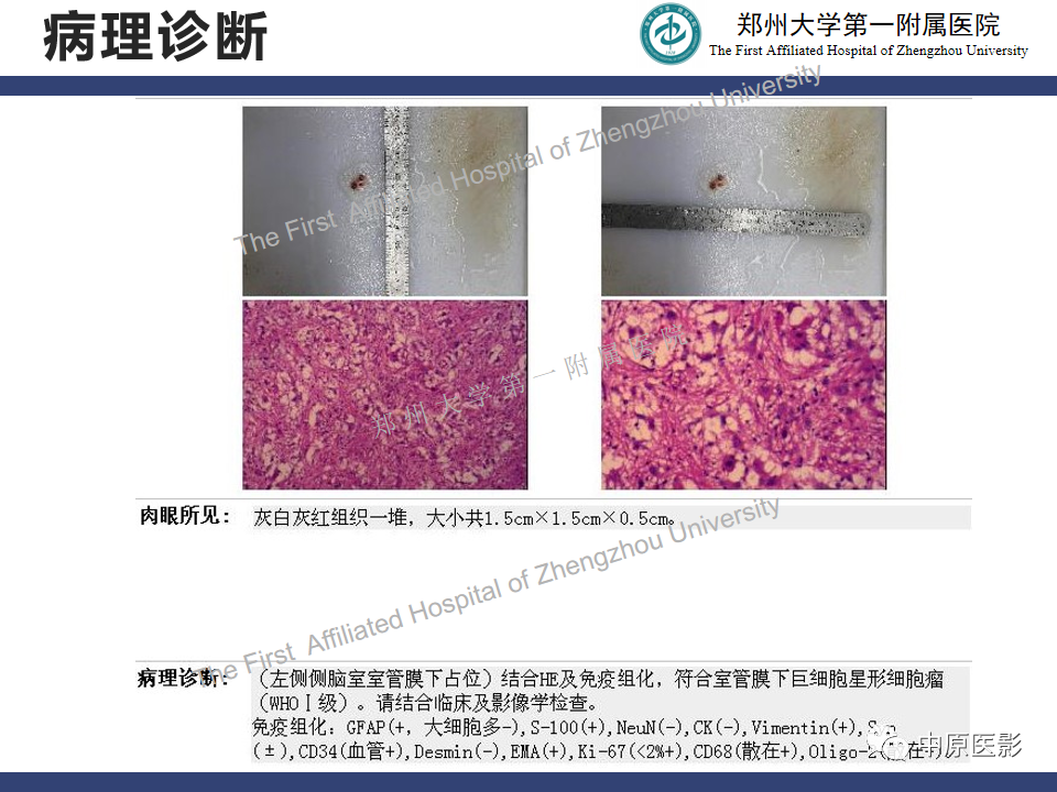 【病例】室管膜下巨细胞星形细胞瘤1例MR影像-9