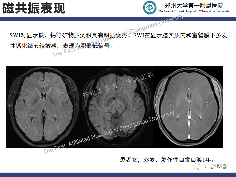 【病例】室管膜下巨细胞星形细胞瘤1例MR影像-13