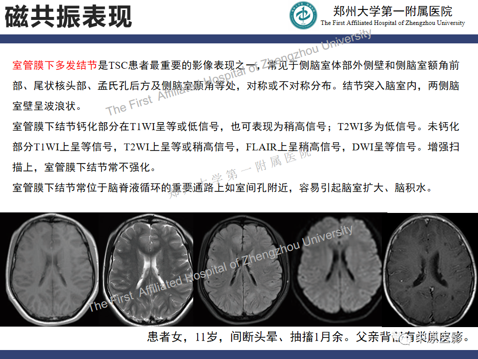 【病例】室管膜下巨细胞星形细胞瘤1例MR影像-12