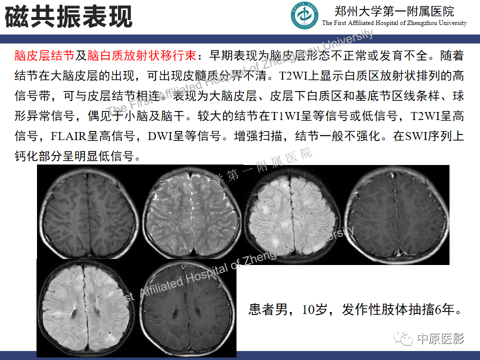 【病例】室管膜下巨细胞星形细胞瘤1例MR影像-14