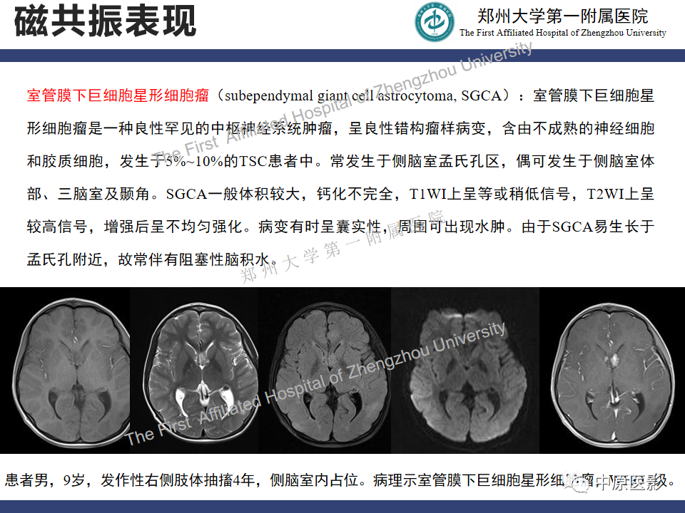 【病例】室管膜下巨细胞星形细胞瘤1例MR影像-15