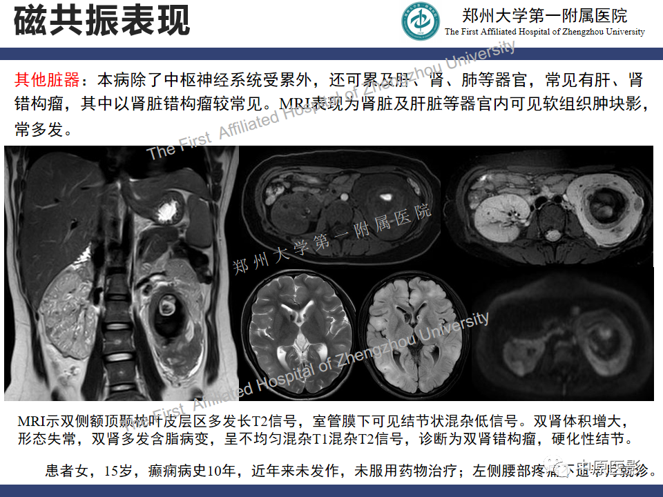 【病例】室管膜下巨细胞星形细胞瘤1例MR影像-16