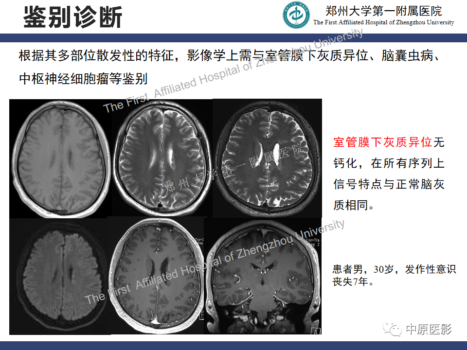 【病例】室管膜下巨细胞星形细胞瘤1例MR影像-18