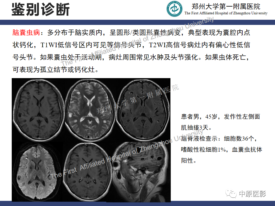 【病例】室管膜下巨细胞星形细胞瘤1例MR影像-19