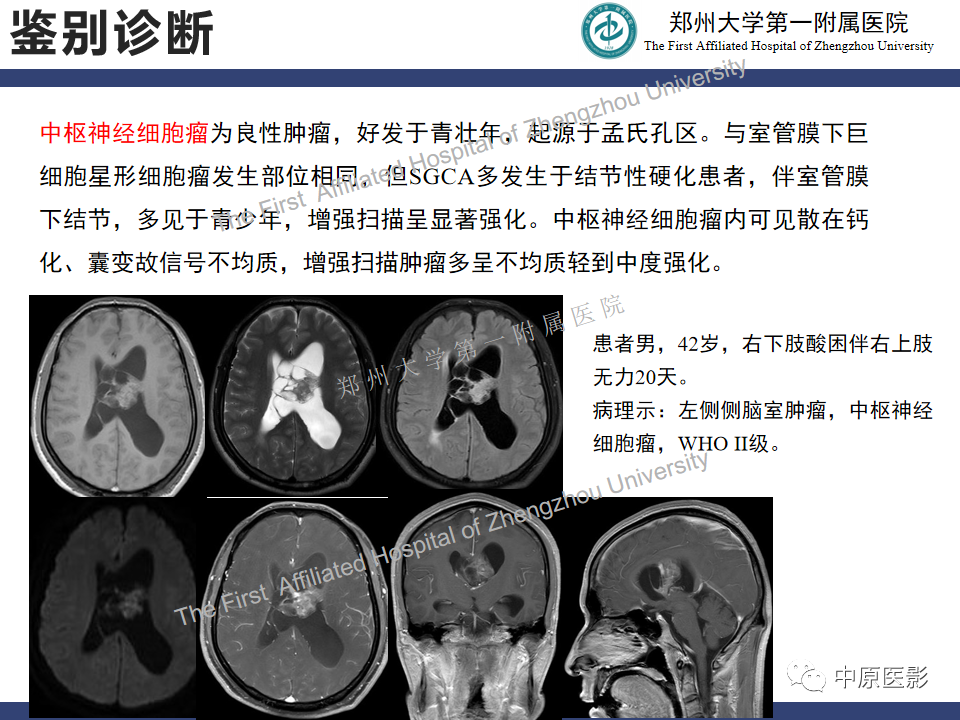 【病例】室管膜下巨细胞星形细胞瘤1例MR影像-20