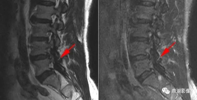 【病例】奥本海默小骨1例CT影像-5