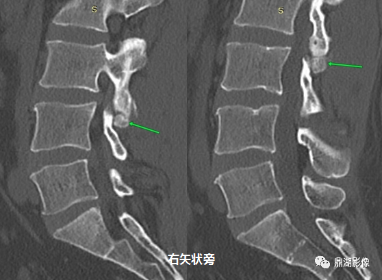 【病例】奥本海默小骨1例CT影像-2