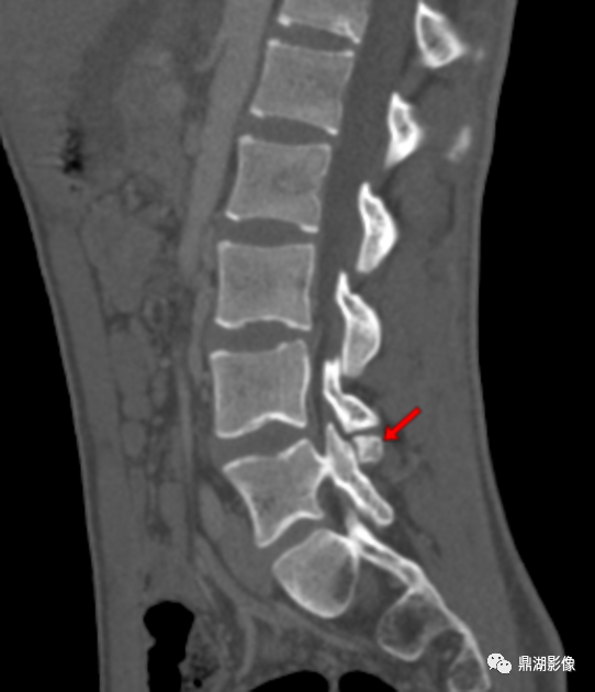 【病例】奥本海默小骨1例CT影像-4