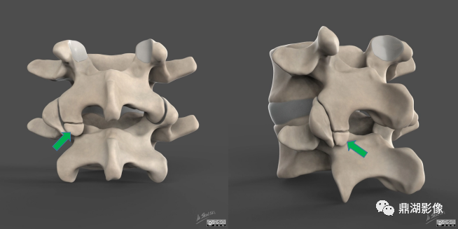 【病例】奥本海默小骨1例CT影像-3