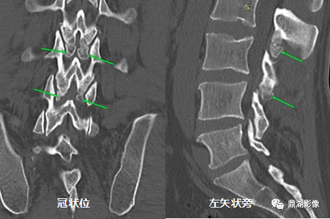 【病例】奥本海默小骨1例CT影像-1