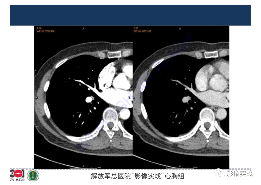 【病例】肺炎性肌纤维母细胞瘤1例CT影像-4