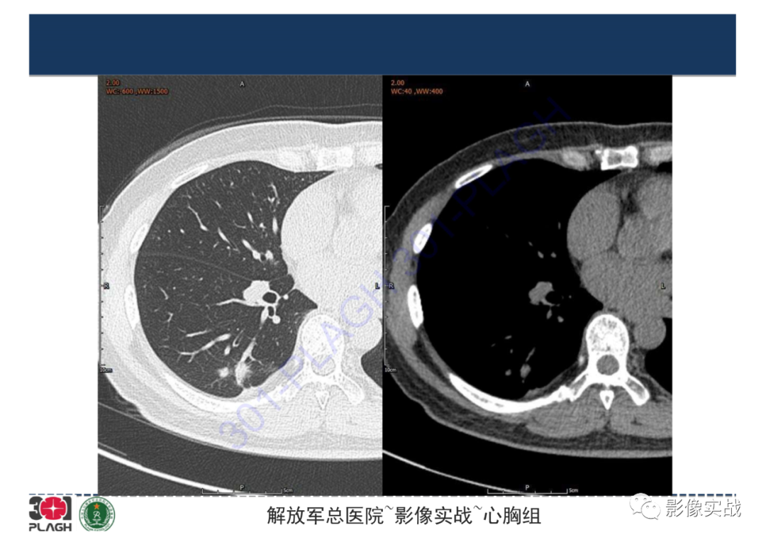 【病例】肺炎性肌纤维母细胞瘤1例CT影像-5