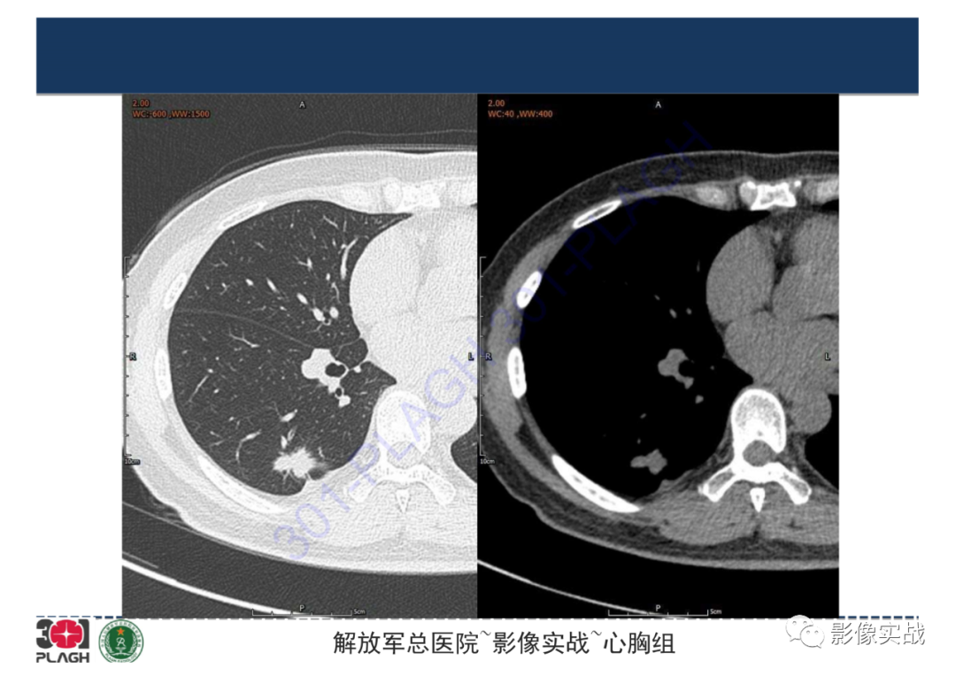 【病例】肺炎性肌纤维母细胞瘤1例CT影像-7