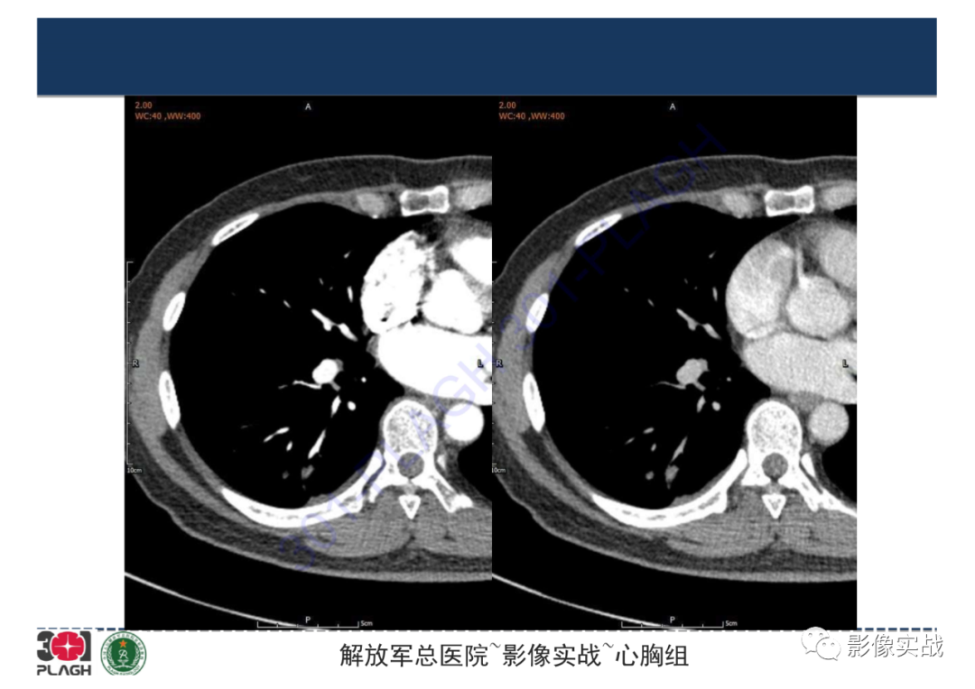 【病例】肺炎性肌纤维母细胞瘤1例CT影像-6