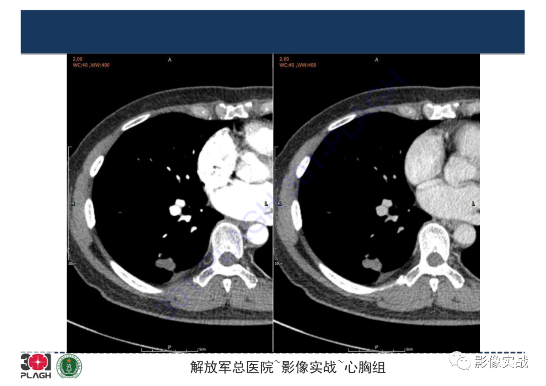【病例】肺炎性肌纤维母细胞瘤1例CT影像-12