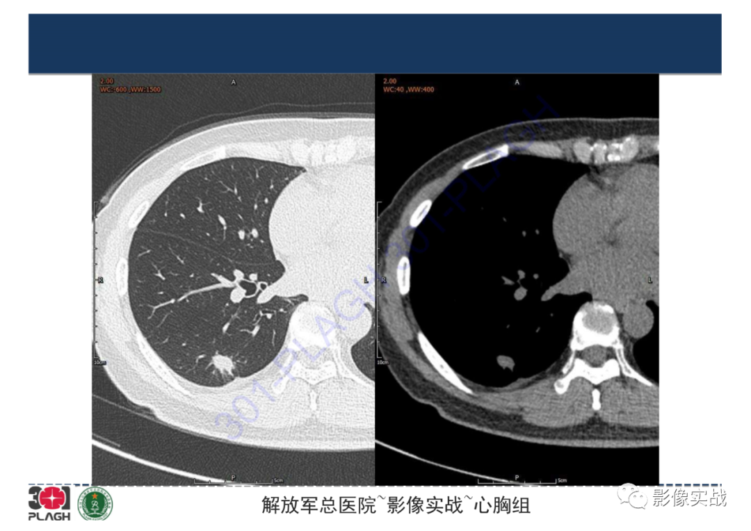 【病例】肺炎性肌纤维母细胞瘤1例CT影像-13