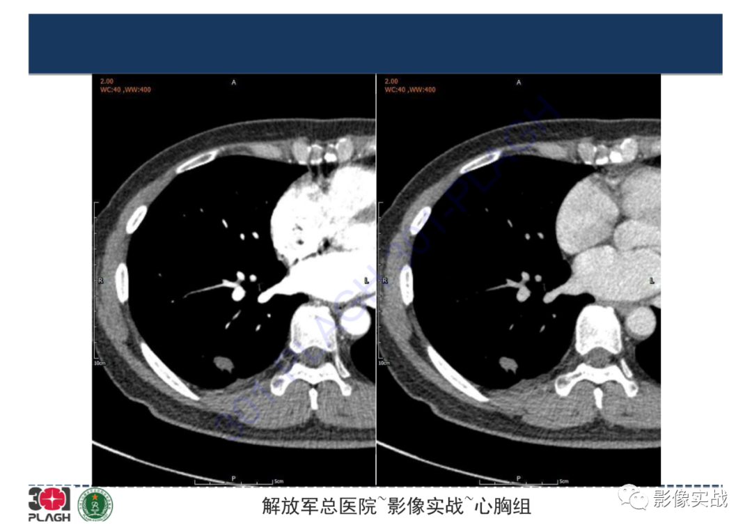 【病例】肺炎性肌纤维母细胞瘤1例CT影像-14