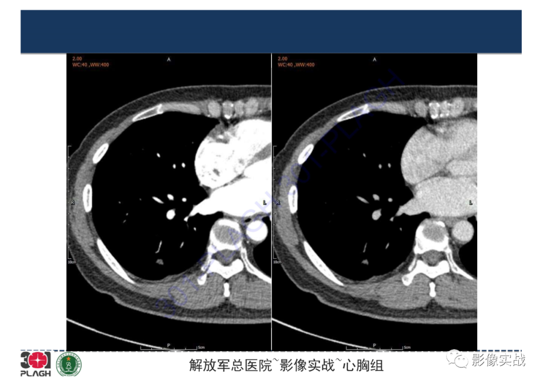【病例】肺炎性肌纤维母细胞瘤1例CT影像-16