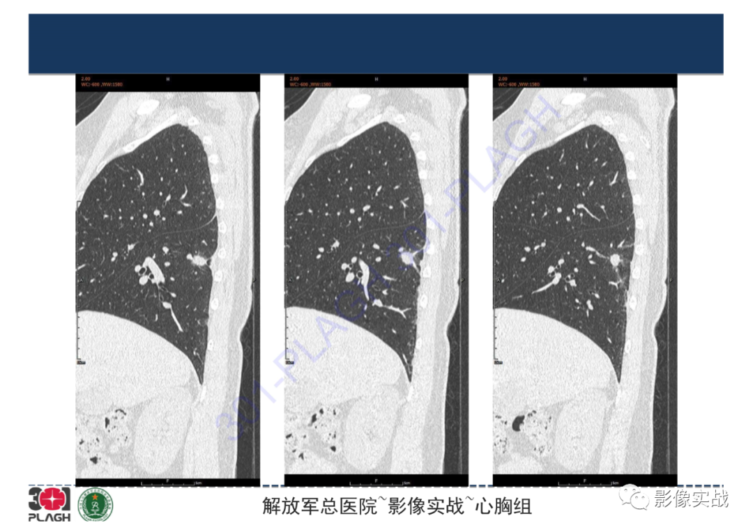 【病例】肺炎性肌纤维母细胞瘤1例CT影像-18