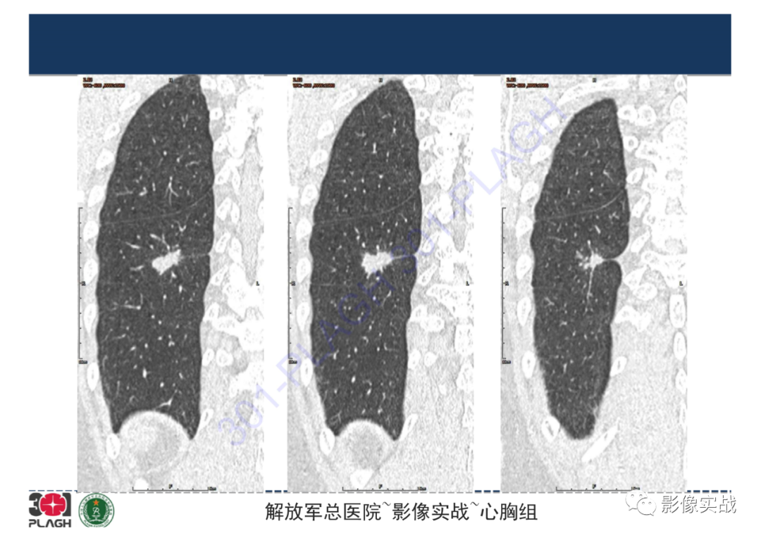 【病例】肺炎性肌纤维母细胞瘤1例CT影像-19