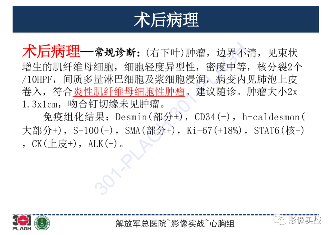 【病例】肺炎性肌纤维母细胞瘤1例CT影像-21