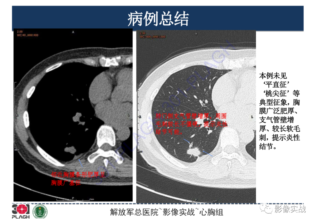 【病例】肺炎性肌纤维母细胞瘤1例CT影像-24
