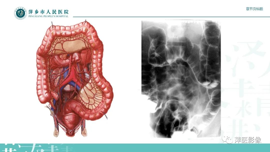 【PPT】肠梗阻读片之小肠篇-6