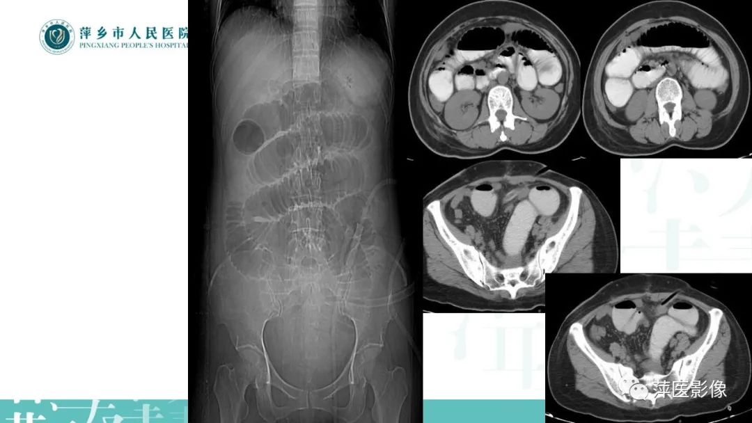 【PPT】肠梗阻读片之小肠篇-17