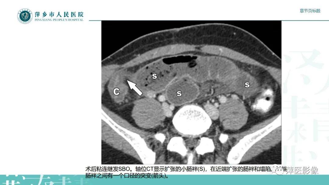 【PPT】肠梗阻读片之小肠篇-19