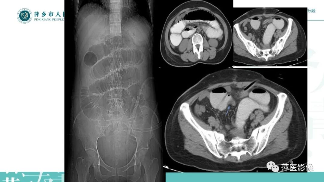 【PPT】肠梗阻读片之小肠篇-20