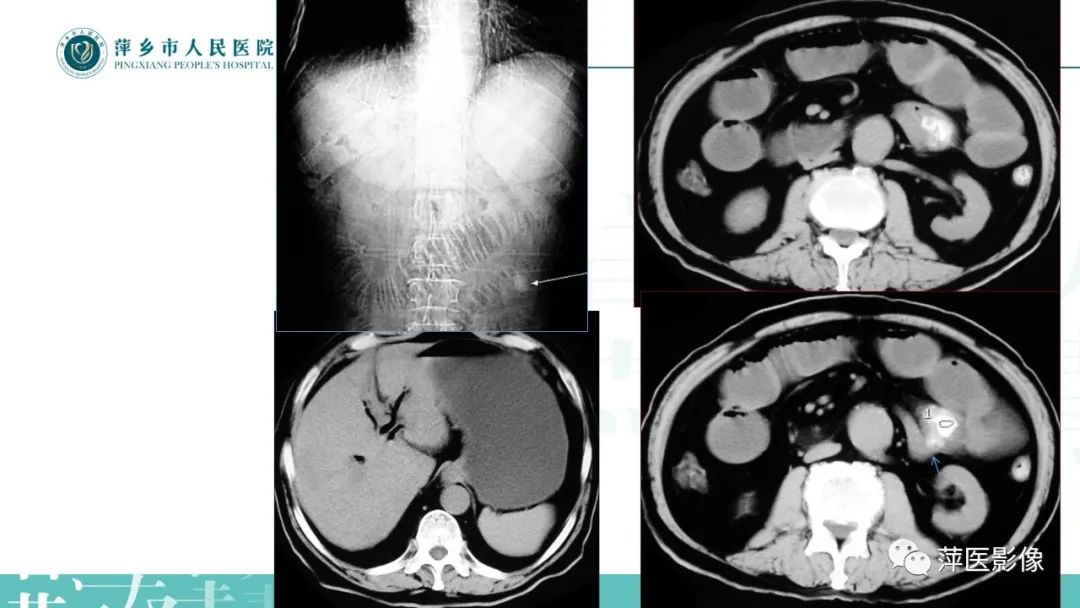 【PPT】肠梗阻读片之小肠篇-21
