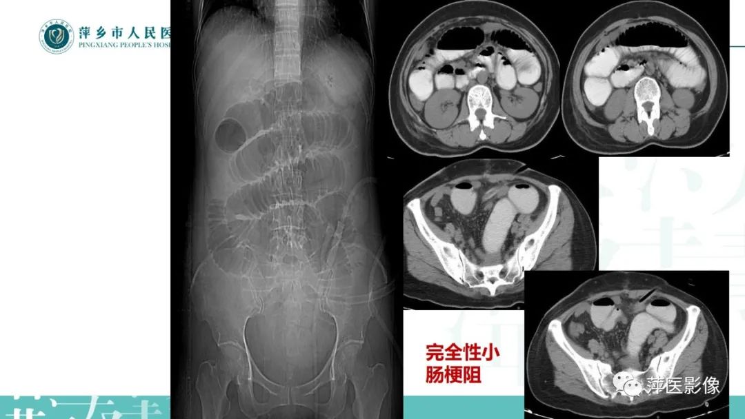 【PPT】肠梗阻读片之小肠篇-24