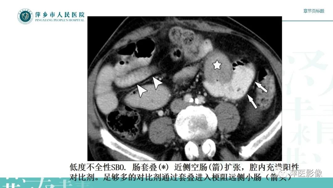 【PPT】肠梗阻读片之小肠篇-25